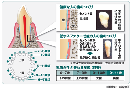 4歳未満なのに乳歯が抜けた 低ホスファターゼ症 Hpp の原因 症状と治療 希少骨疾患 4歳未満なのに乳歯が抜けた 低ホスファターゼ症 Hpp の原因 症状と治療 希少骨疾患